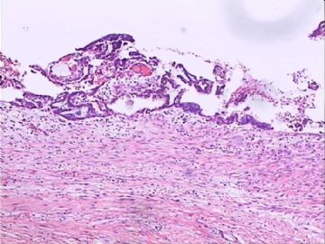 交界性浆液性囊腺瘤？囊腺癌？交界性局部癌变?图4