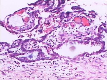 交界性浆液性囊腺瘤？囊腺癌？交界性局部癌变?图5