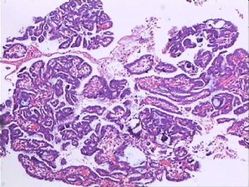 交界性浆液性囊腺瘤？囊腺癌？交界性局部癌变?图6