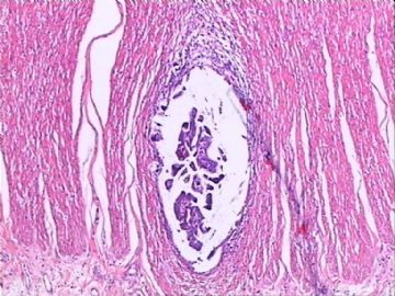 交界性浆液性囊腺瘤？囊腺癌？交界性局部癌变?图12