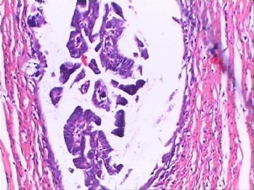 交界性浆液性囊腺瘤？囊腺癌？交界性局部癌变?图13