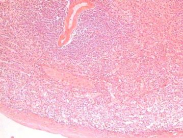 胃癌标本大弯侧少见肿物图1