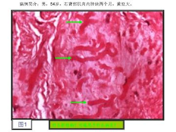 基础病理图片讨论-1（答案公布）图1