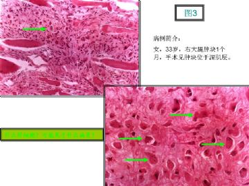 基础病理图片讨论-1（答案公布）图3