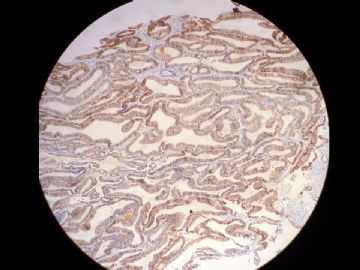 协助判断子宫内膜C-erB-2结果图1