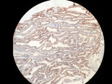 协助判断子宫内膜C-erB-2结果图7