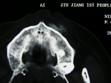 发现上颌骨肿块一个月图10