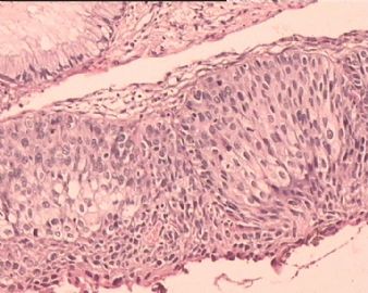 TCT涂片：HSIL。这是宫颈组织多点切片，请各位老师看看。图1