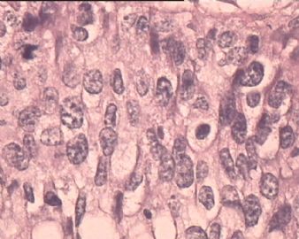 TCT涂片：HSIL。这是宫颈组织多点切片，请各位老师看看。图2