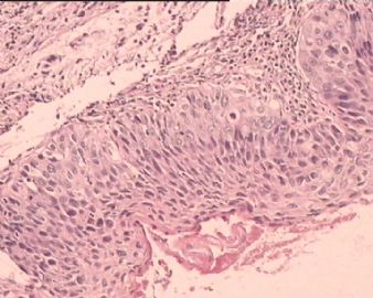 TCT涂片：HSIL。这是宫颈组织多点切片，请各位老师看看。图3