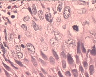 TCT涂片：HSIL。这是宫颈组织多点切片，请各位老师看看。图4