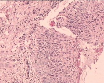 TCT涂片：HSIL。这是宫颈组织多点切片，请各位老师看看。图5