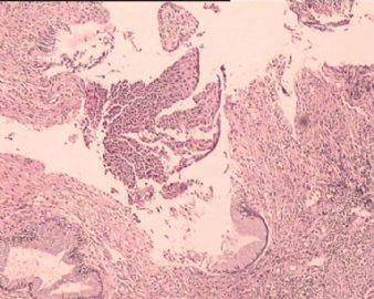 TCT涂片：HSIL。这是宫颈组织多点切片，请各位老师看看。图7