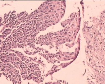 TCT涂片：HSIL。这是宫颈组织多点切片，请各位老师看看。图8