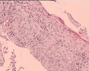 TCT涂片：HSIL。这是宫颈组织多点切片，请各位老师看看。图9