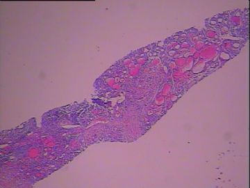 甲状腺粗针穿刺图1