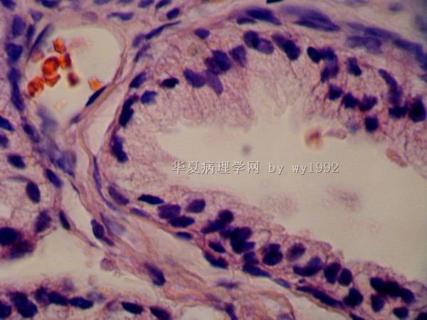 201009704(386671)前列腺碎组织图2