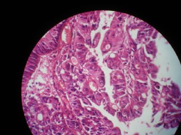 男 55岁  距肛5公分结节状新生物 表面光滑图3