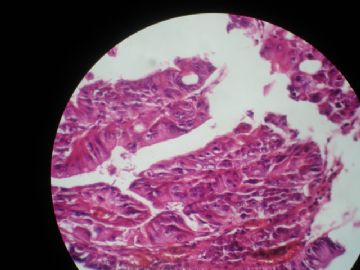 男 55岁  距肛5公分结节状新生物 表面光滑图4