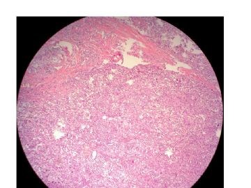 左乳腺肿块(新加免疫组化)图2