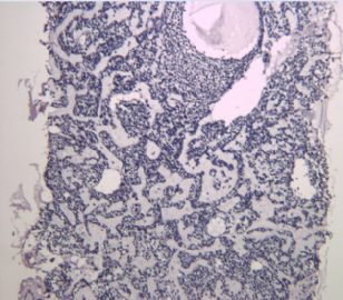 肿瘤穿刺组织图1