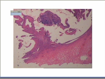 宫颈赘生物图3