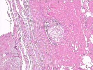 纤维腺瘤里可以有泡沫细胞吗？图2