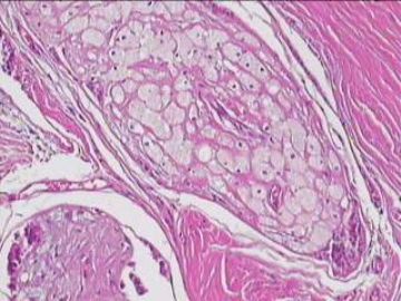 纤维腺瘤里可以有泡沫细胞吗？图3