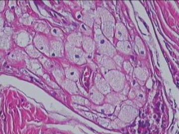 纤维腺瘤里可以有泡沫细胞吗？图4