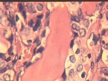 桥本氏甲状腺炎广泛取材局灶见一微小结节，是否癌变图10