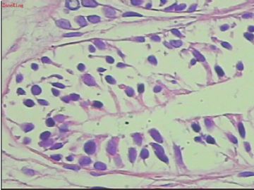 前列腺电切组织，这些腺体有问题吗？图6