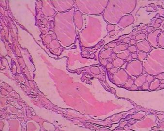 甲状腺包块图5