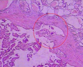 甲状腺包块图11