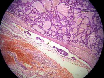 甲状腺（血管侵犯？）图13