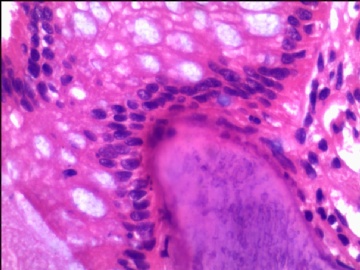 直肠活检出现骨化图7