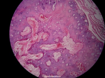骨软骨瘤图11