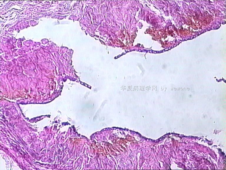 腹膜后囊肿，大家看看是什么？图16