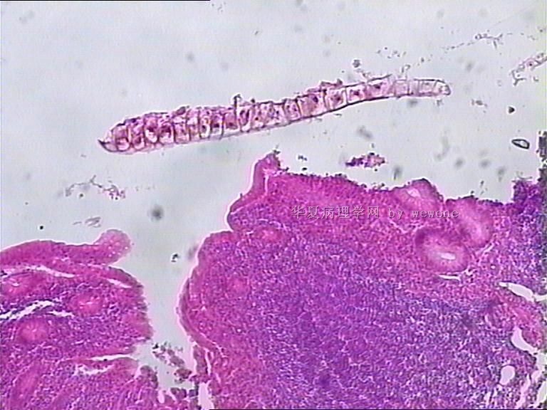 阑尾末端腔内物，像寄生虫，但不知是什么寄生虫？？？大家帮忙看看啊图2