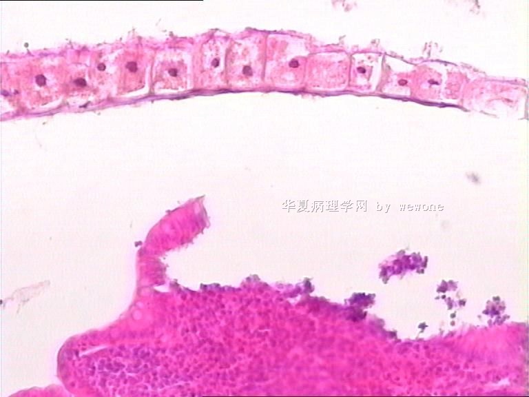 阑尾末端腔内物，像寄生虫，但不知是什么寄生虫？？？大家帮忙看看啊图3