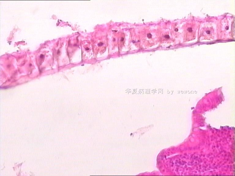 阑尾末端腔内物，像寄生虫，但不知是什么寄生虫？？？大家帮忙看看啊图4