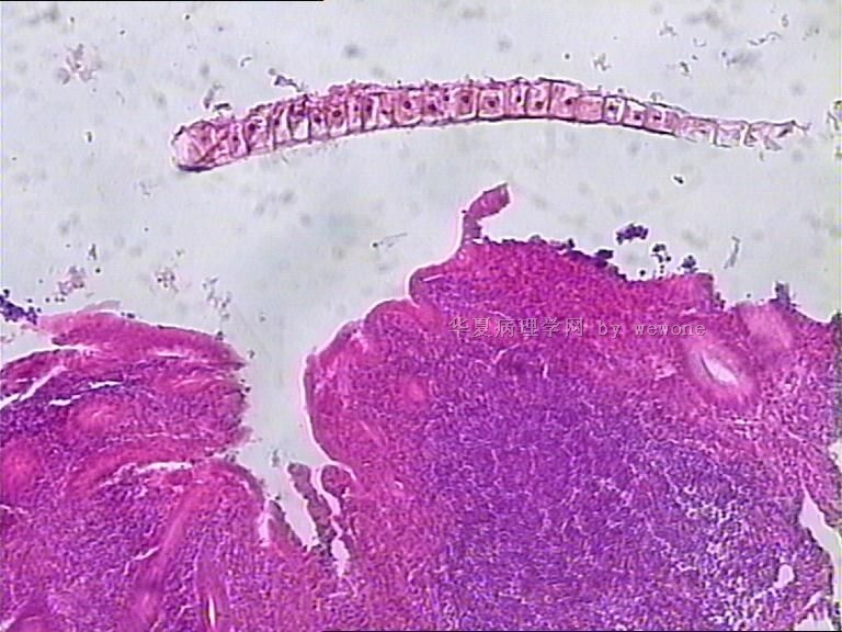 阑尾末端腔内物，像寄生虫，但不知是什么寄生虫？？？大家帮忙看看啊图5