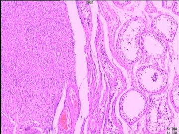 睾丸肿物，2月12日重染组化结果！！图8