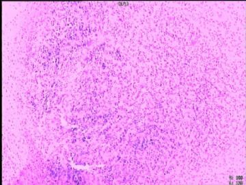 室管膜瘤与毛细胞星型细胞瘤可合并存在吗？图1