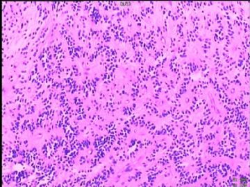 室管膜瘤与毛细胞星型细胞瘤可合并存在吗？图2