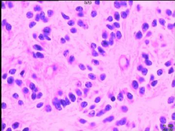 室管膜瘤与毛细胞星型细胞瘤可合并存在吗？图3