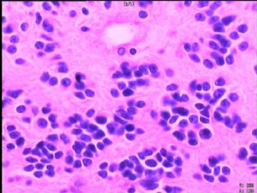 室管膜瘤与毛细胞星型细胞瘤可合并存在吗？图4