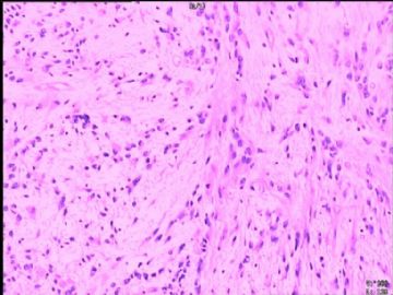 室管膜瘤与毛细胞星型细胞瘤可合并存在吗？图6