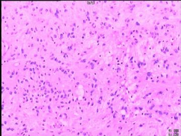 室管膜瘤与毛细胞星型细胞瘤可合并存在吗？图7