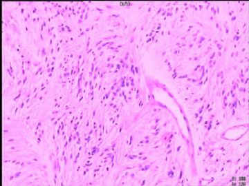 室管膜瘤与毛细胞星型细胞瘤可合并存在吗？图9
