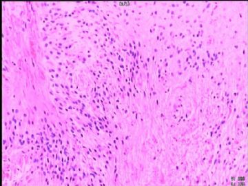 室管膜瘤与毛细胞星型细胞瘤可合并存在吗？图12